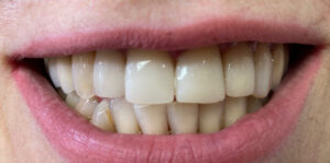 Реставрация зубов DPH клинка - после